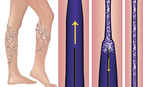 nodurile varicoase sub tratamentul genunchiului